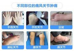 临床总结：诱发痛风发作的四大因素