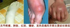 【早期症状】痛风发病早期有哪些显著症状表现