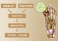 走出治疗误区，选择规范化治疗痛风，才能避免