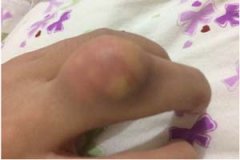 个体化科学治痛风 根源清石降尿酸抗减少发作